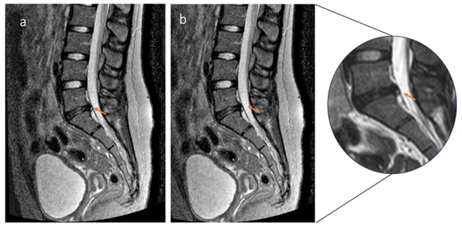 Figure 1: MRI of a 15 years-old girl with L4-L5 disc herniation and
neurogenic bladder. Sagittal Short Tau Inversion Recovery (STIR)
WI (a) and Sagittal T2WI (b) show posterior displacement of the
L4–L5 disc (orange arrows). The height of the disc is reduced and
there is focal hyperintensity within the posterior L4–L5 disc compatible with the annulus fibrous fissure (orange arrows).