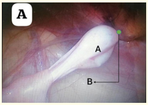 Figure 5: Showing Testis after fixation to the contralateral side.