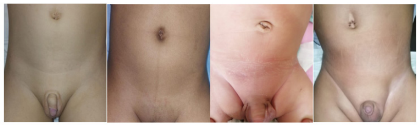 Figure 6: Follow up photos 3 months post-operative.