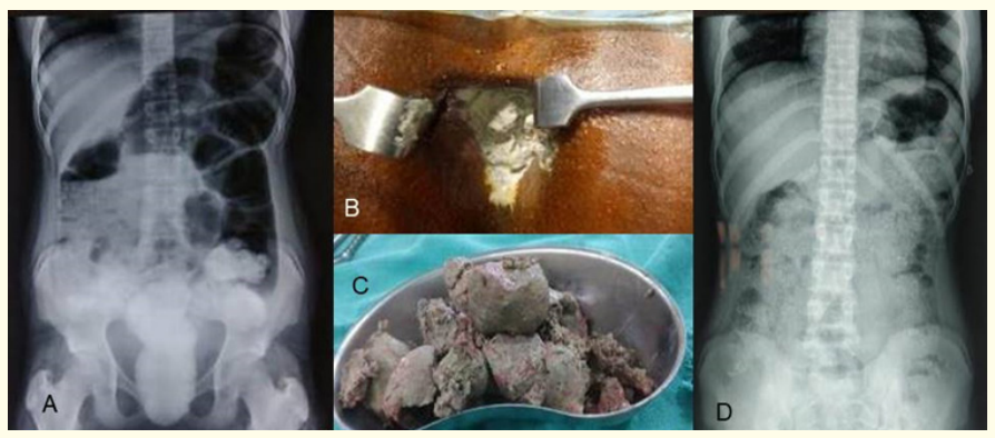 Figure 1: (A) Plain X-ray of the erect abdomen showing dilated air-filled colonic loops with a huge opacified mass occupying the rectal lumen extending up to the sigmoid colon. (B) Chalkolith visible through the anal orifice; (C): Chalkolith evacuated per rectally, (D) Follow-up X-ray abdomen erect showing persistent diffuse punctate calcification in the colonic wall.