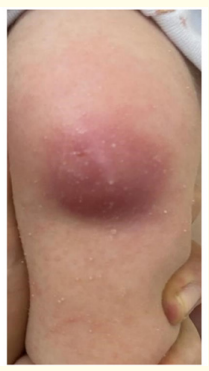 Figure 1: Clinical image of the exuberant swelling at the site of
vaccine administration.