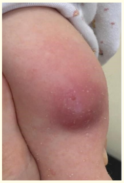 Figure 2: Clinical image of the exuberant swelling at the site of
vaccine administration.