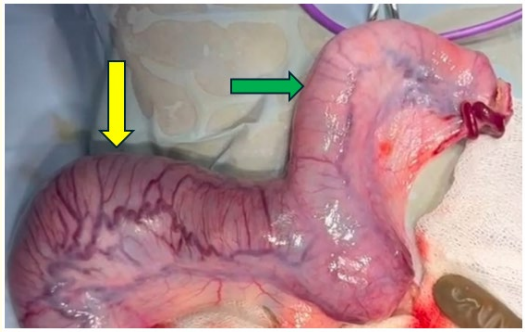 Figure 2: Uterine horns after correcting uterine intussusception
yellow indicates gravid uterine horn with non-viable fetus and
green arrow indicates non-gravid uterine horn after correction.