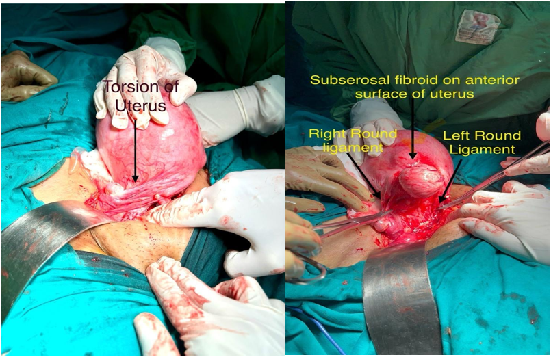 Figure 1: A. Intraoperative picture with torsion. B. After detorsion of the uterus.