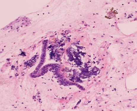 Figure 2: Histology, scant benign endometrium, H & E stain, medium power.