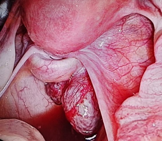 Figure 1: Intraoperative photo of three splenunculi in the 
pouch of douglas infilterating the right pararectal space.