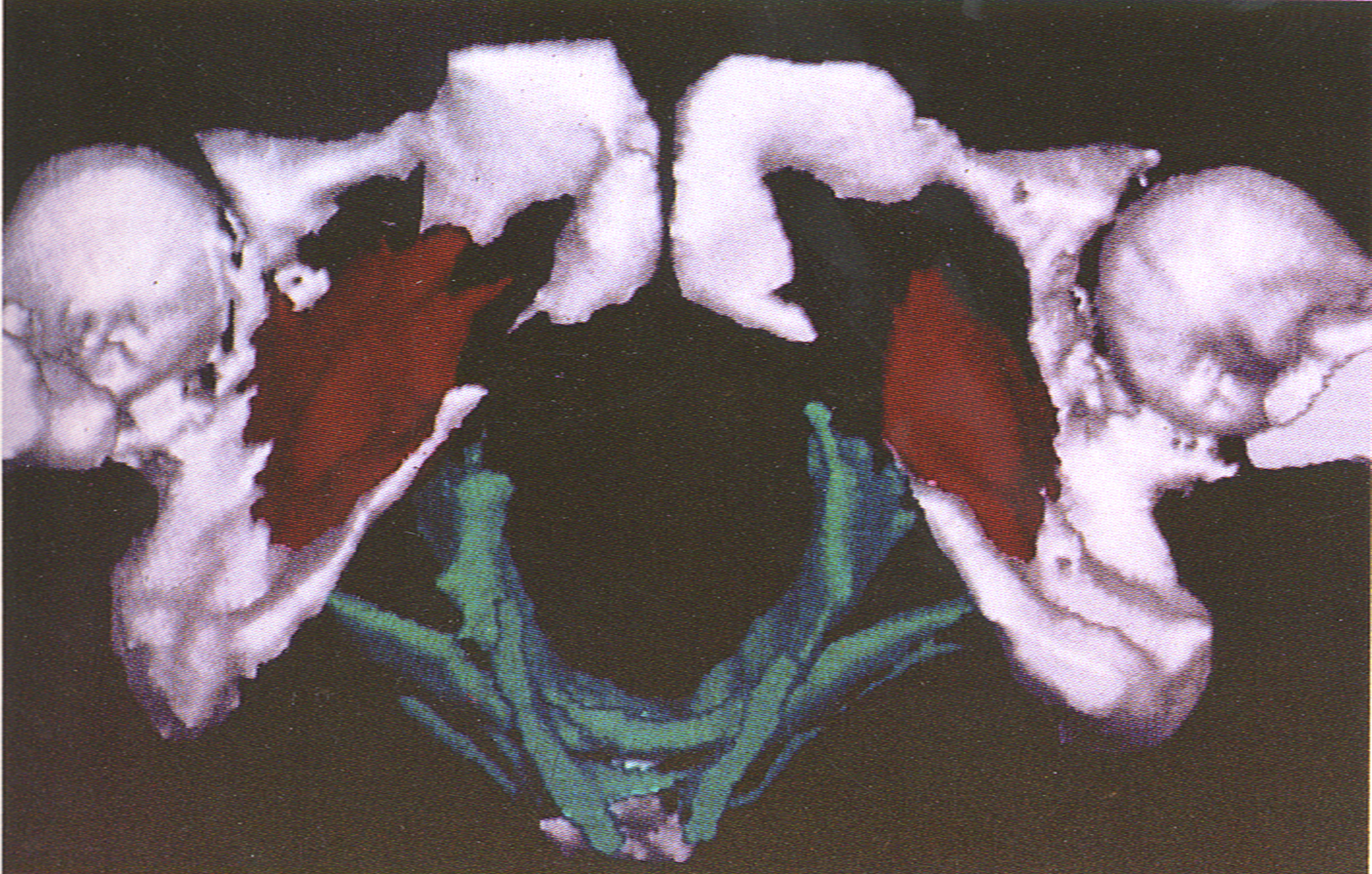 Figure 1: The 3-dimensional models determine LAM volume, shape and hiatus width, distance between symphysis and levator sling muscle; The obturator internus muscles are bilaterally connected to bony pelvis. 