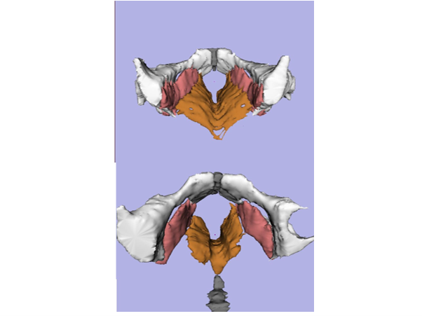 Figure 2: Levator avulsion can be diagnosed reliably by MRI evaluation and have shown an association between LAM avulsion and the development of pelvic floor prolapse in later life. Women have a higher incidence of LAM avulsion and show a wider urogenital hiatus and levator hiatus.