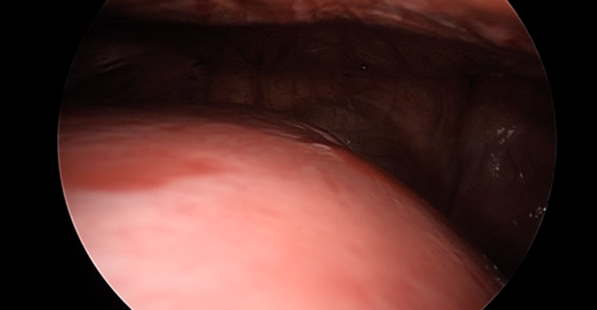 Figure 1: Intraoperative picture of the fibroid after supraumbilical access.