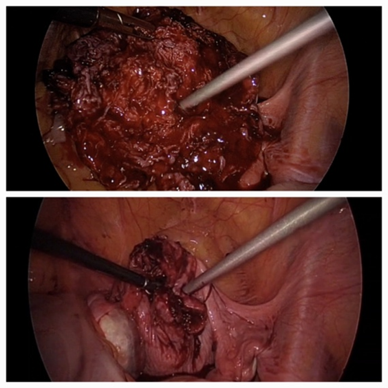 Figure 3: Intraoperative picture of the uterine posterior wall after removal of the fibroid.