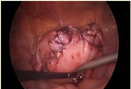 Figure 4: Intraoperative picture of the uterus after a multilayer reconstruction of the posterior wall.