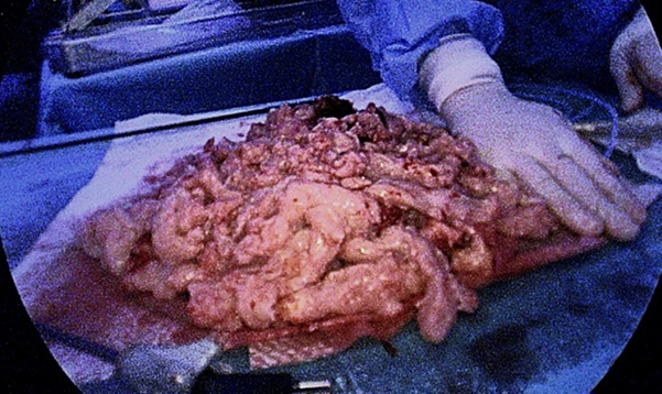 Figure 5: Picture of the fibroid after morcellation: 1460 g.