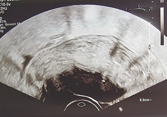 Figure 6: Ultrasound picture two months postoperatively showing a full thickness posterior uterine wall.